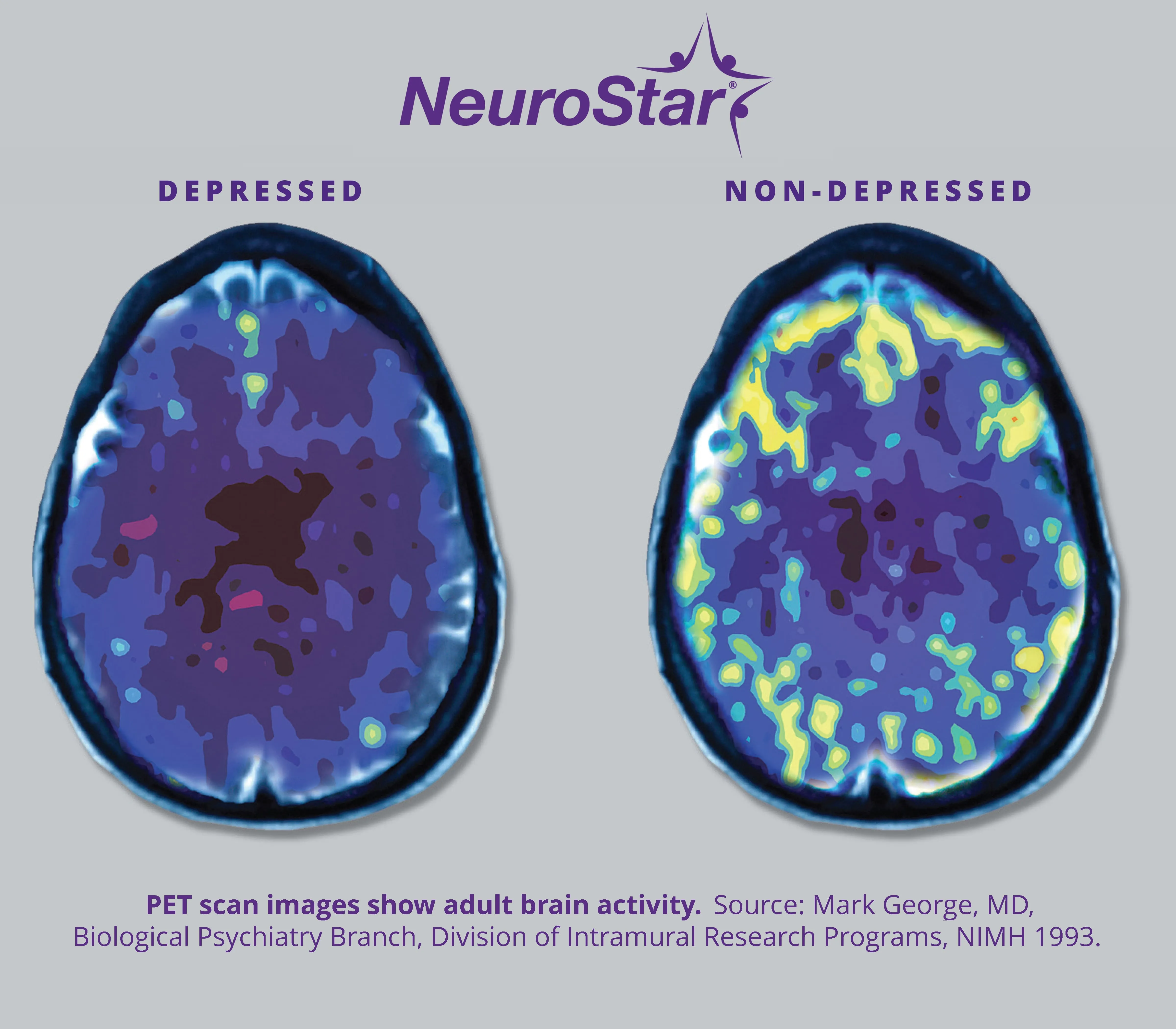 Neuroplasticity Visual